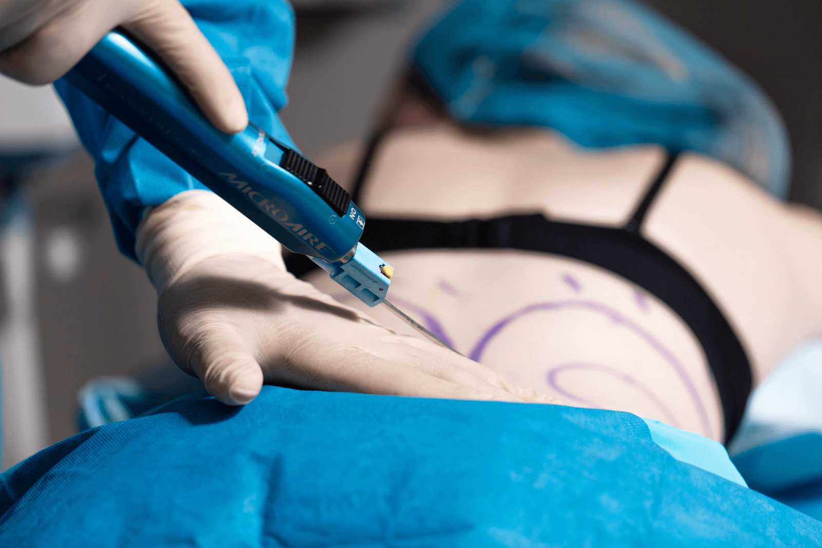 Chirurgical procedure